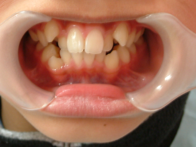 子供の矯正　八重歯　ワイヤー矯正