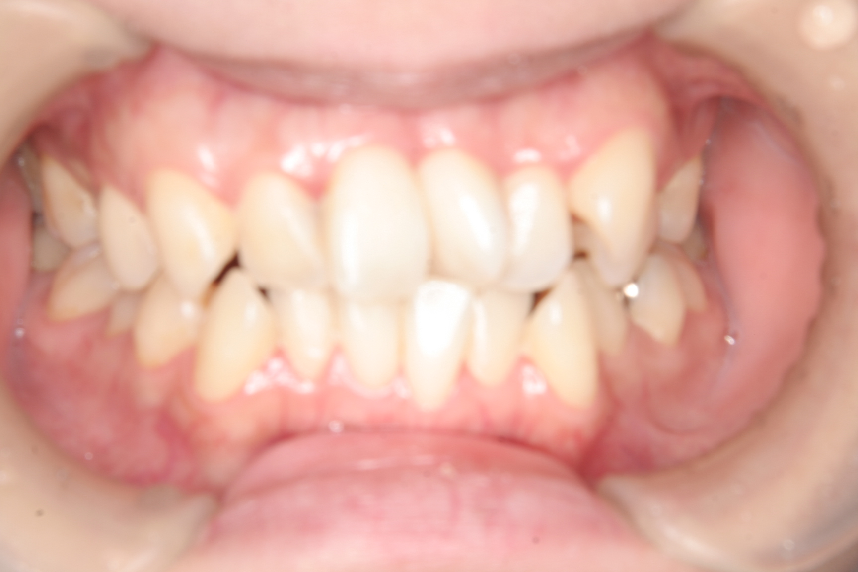 桑名市前歯が90度回転しているんですけど治療期間を短くする矯正歯科