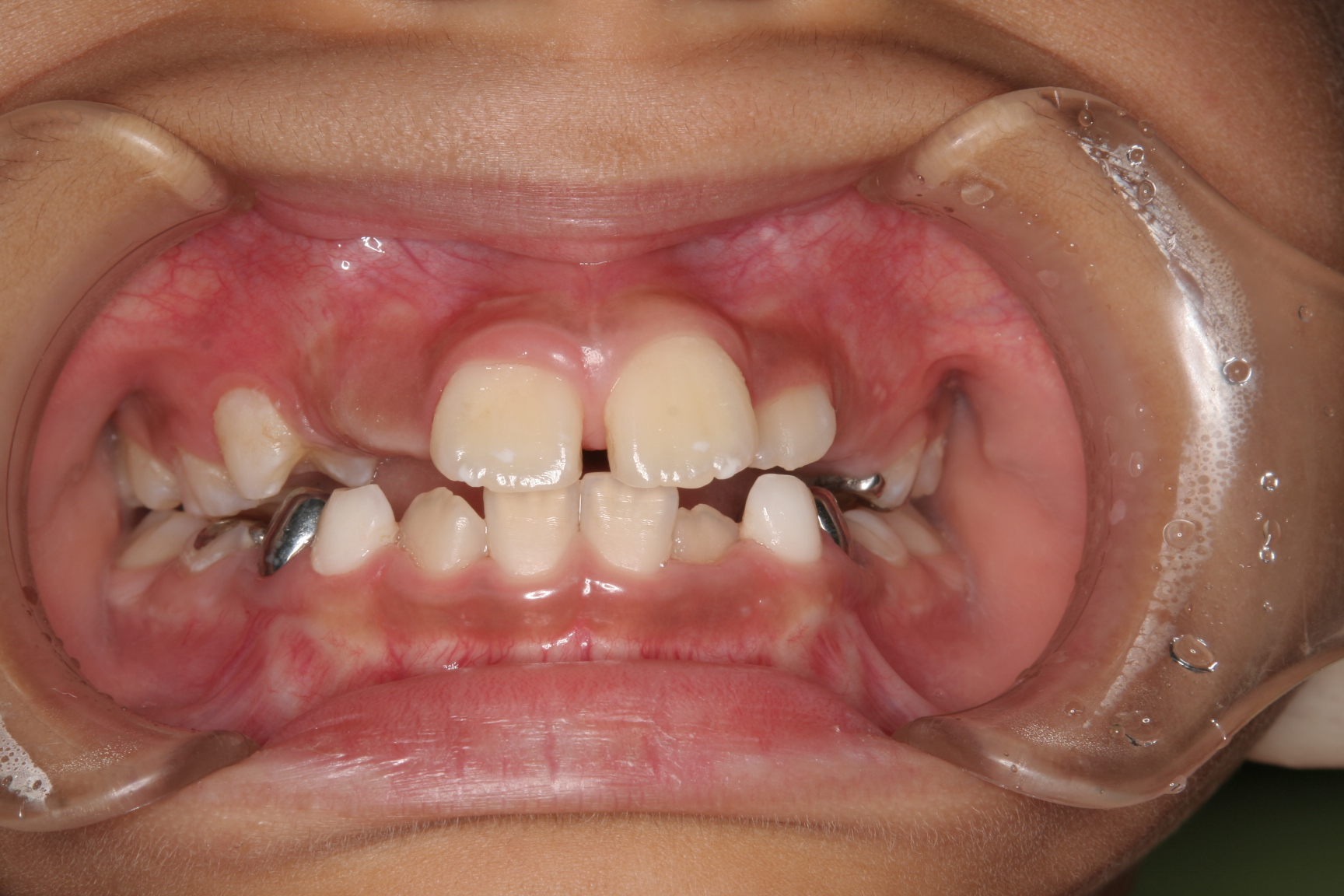 菰野町顎が小さくて大人の歯が並びそうにないんですけど出来るだけ歯を抜かない矯正歯科