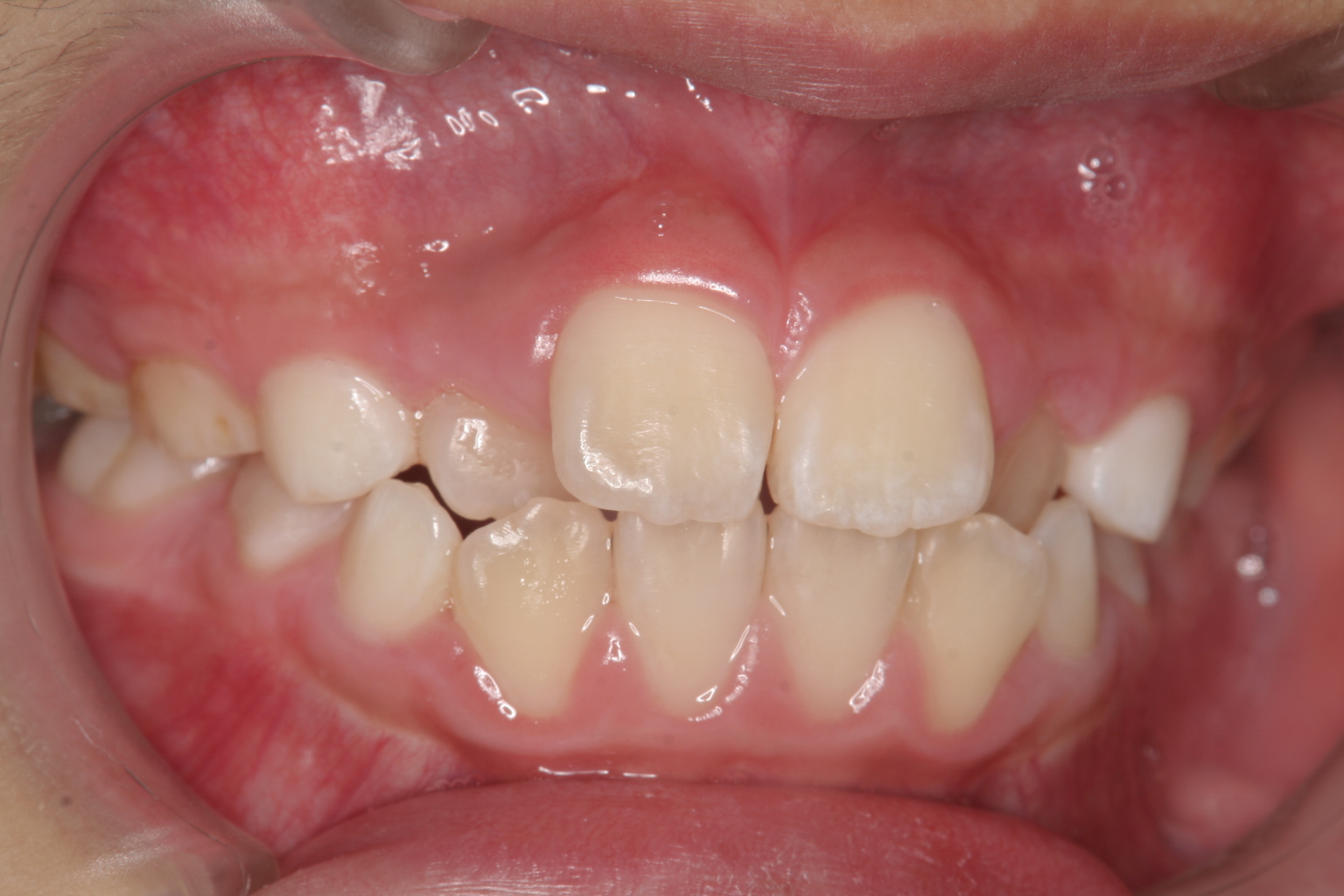 顎が小さくて2番目の歯が内側に生えているんですけれど桑名市出来るだけ歯を抜かない矯正歯科