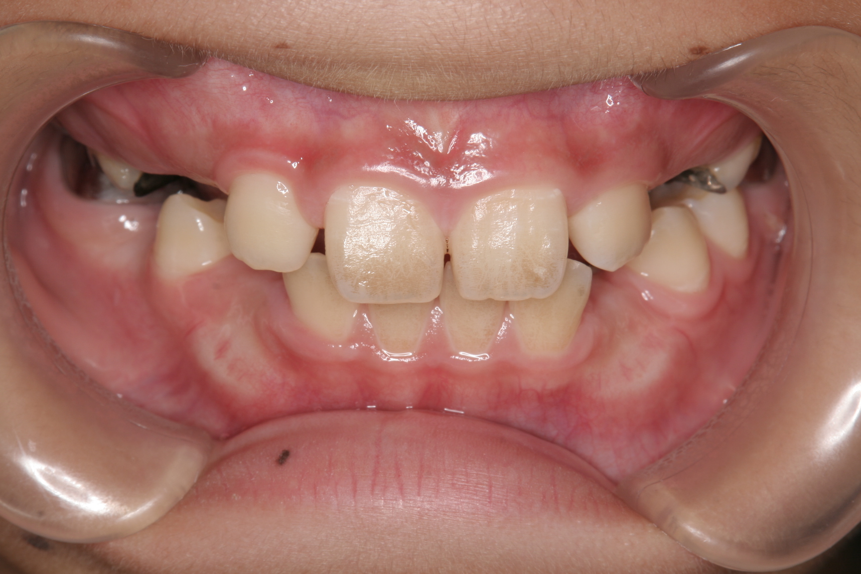 顎が小さくて大人の歯が並びそうにないんですけどいなべ市出来るだけ歯を抜かない矯正歯科