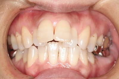 上顎前突（出っ歯）東員町および四日市市部分矯正と審美歯科で治す矯正歯科