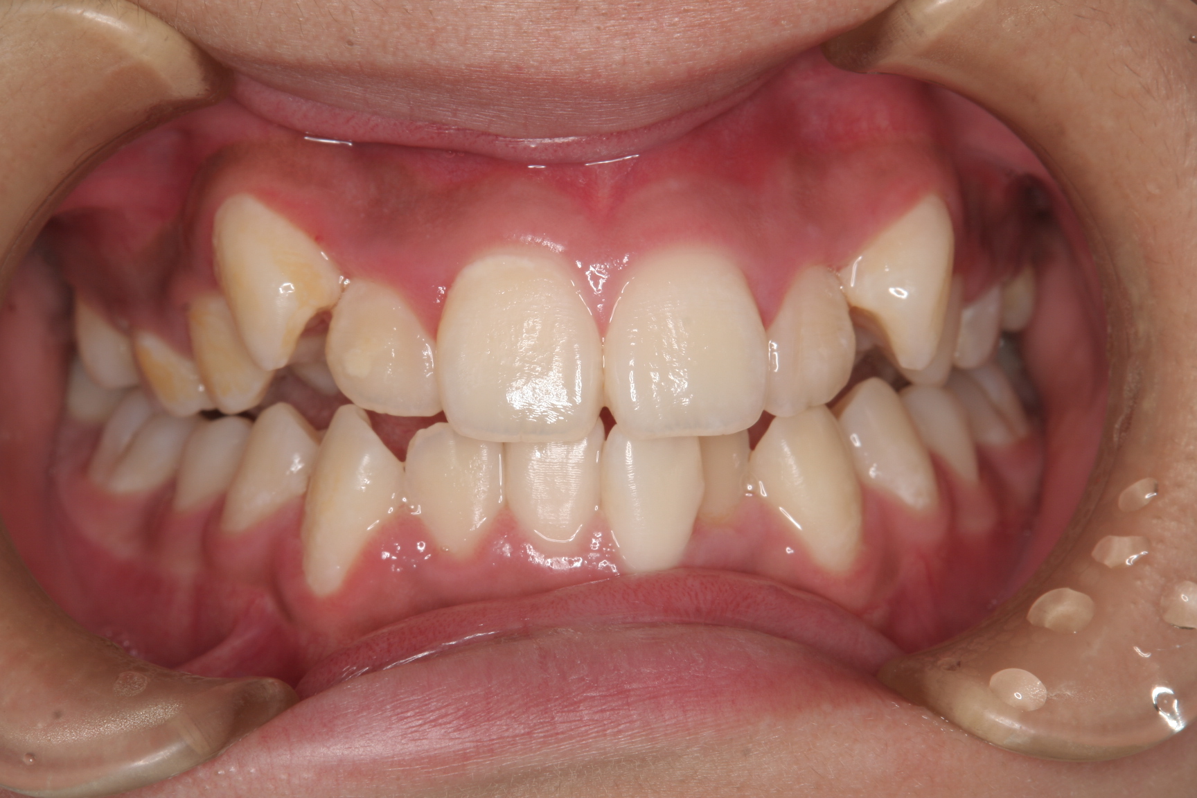 桑名市八重歯なんですけど短期間で治す矯正歯科