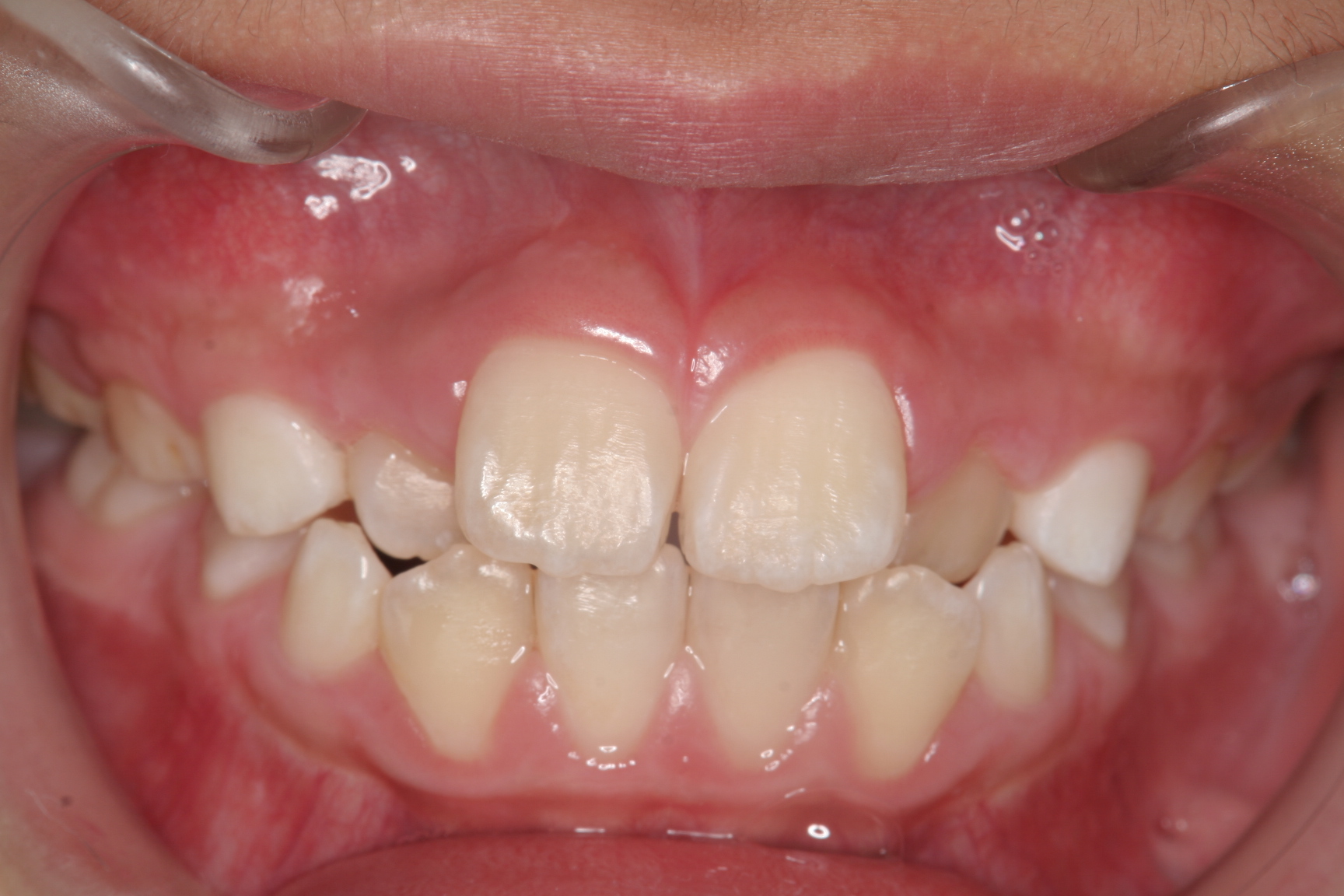 菰野町顎が小さくて大人の歯が並ばないんですけど出来るだけ歯を抜かない矯正歯科
