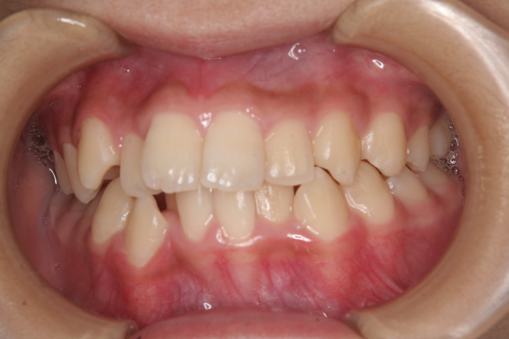 菰野町顎が小さくて大人の歯が並ばないんですが治療期間を短くする矯正歯科