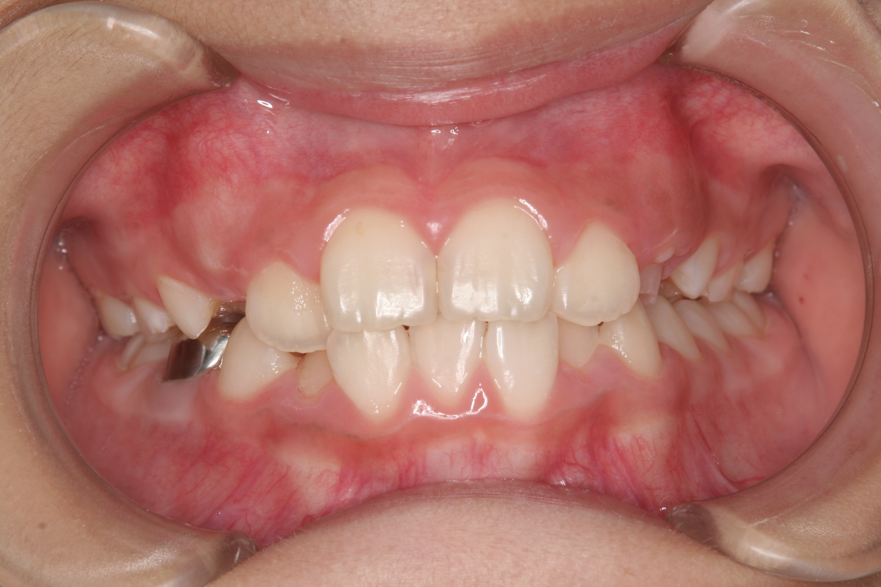 菰野町顎が小さくて歯が並びそうにないんです。出来るだけ歯を抜かない矯正歯科