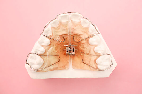 歯列矯正での第1期治療