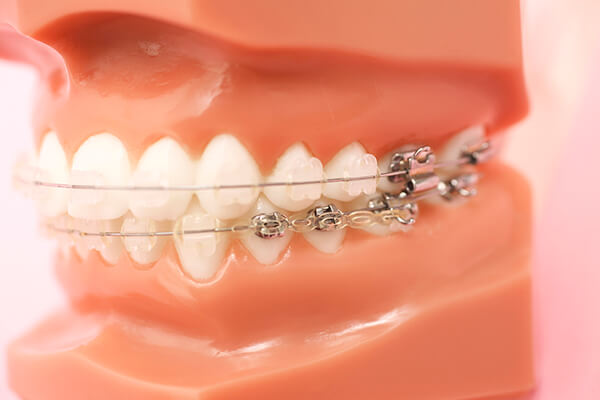 歯列矯正での第2期治療